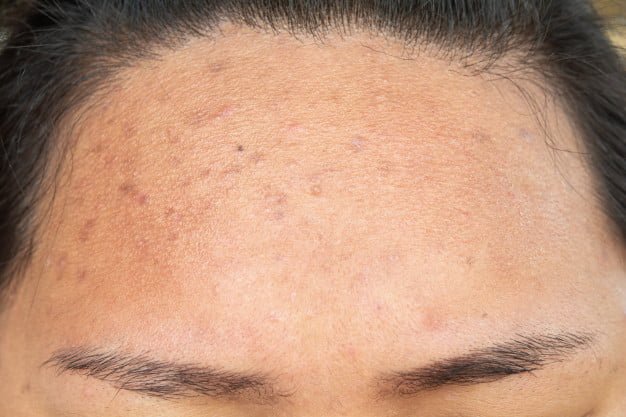 Laserowe leczenie przebarwień