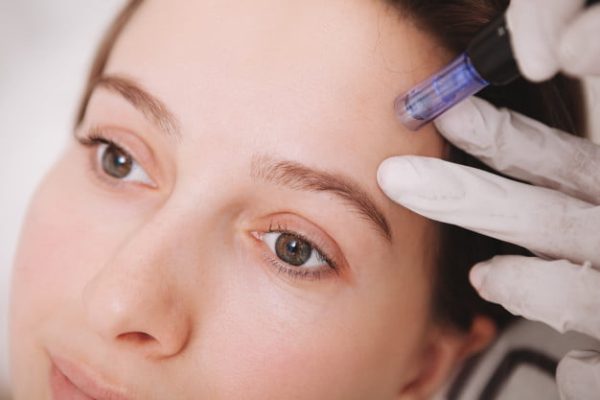 Dermapen 4 Dermapen zmarszczki czoła
