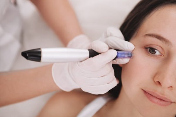 Dermapen 2 Dermapen policzki