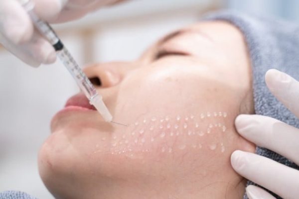 Redukcja cieni pod oczami 1 mezoterapia igłowa