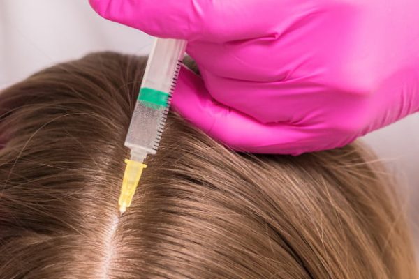 Zabiegi stymulujące na włosy 1 Mezoterapia skóry głowy na włosy