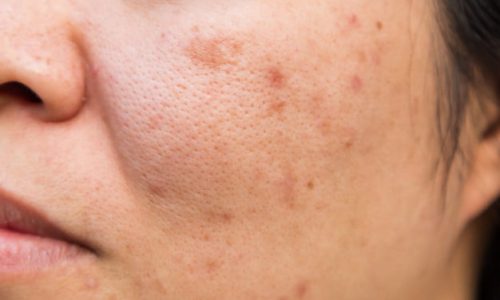blizny i przebarwienia po trądziku
